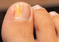 Fungal Nails – Current Thinking and Treatment